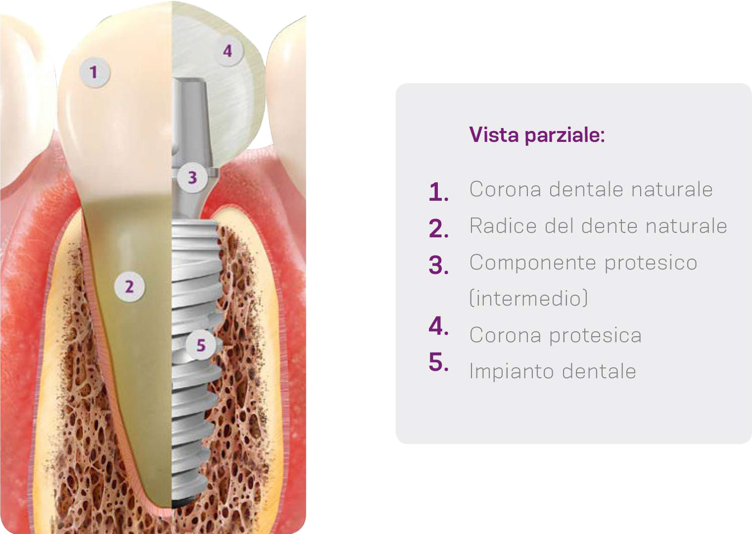 Cos'è l'implantologia?